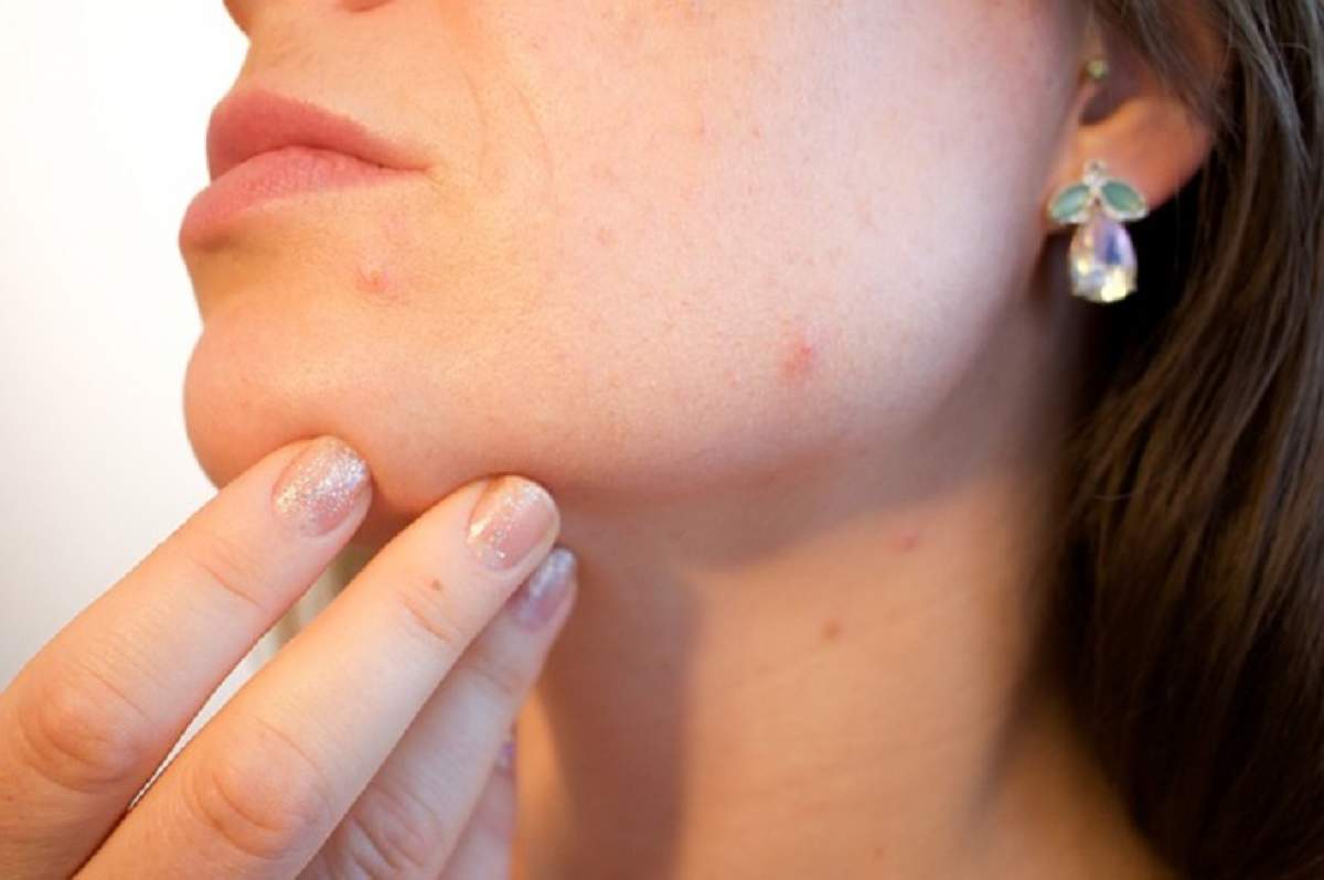 Cum să scapi rapid de cicatricile şi semnele lăsate de acnee