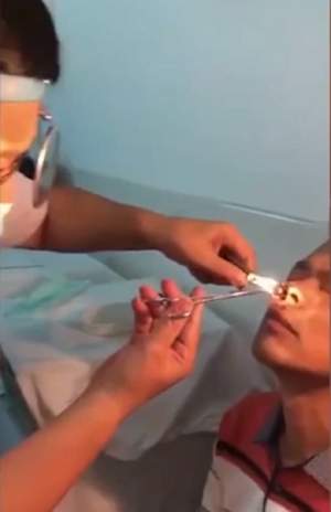 VIDEO /  A avut sângerări nazale timp de 10 zile şi a mers la medic! Bărbatul a rămas şocat când a văzut ce poate să iasă din nara sa