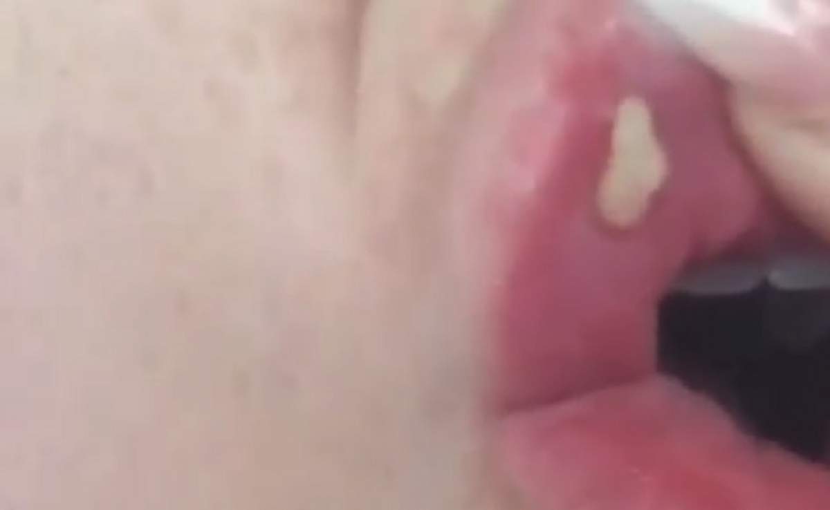 VIDEO / A vrut să-şi mărească buzele la un preţ redus, dar s-a ales cu ceva dezgustător! Când a ajuns la medic a trăit un mare şoc