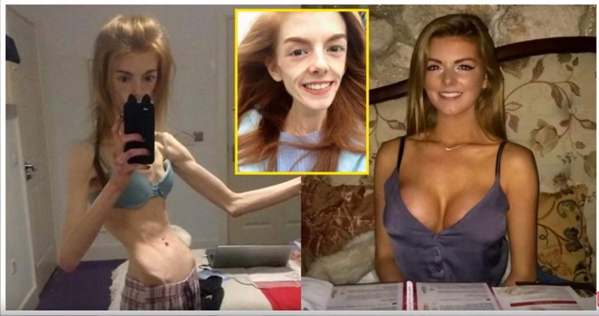 VIDEO / „Am fost la un pas de infarct, atât eram de slabă!” Ajunsese să cântărească 28,5 kilograme! Cum arată acum femeia