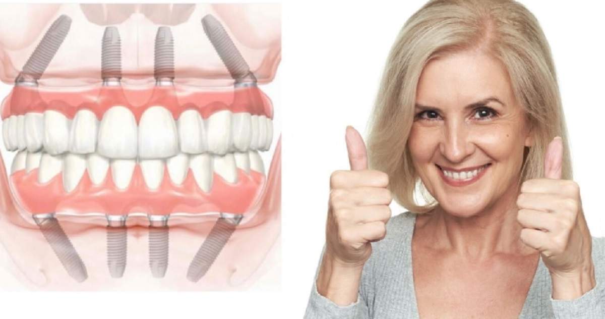 Procedura "dinți într-o zi" se viralizează. Totul despre fast&fixed