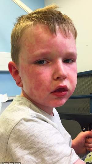 Prin ce dramă trece un băieţel alergic la iarnă? Medicii sunt şocaţi de cazul micuţului. FOTO