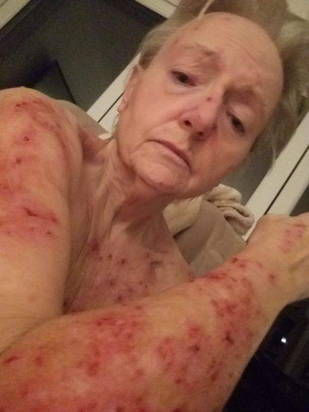 Imagini șocante! Cum arată femeia căreia i-au ieșit, la propriu, bube pe piele, din cauză că nu a mai primit pensia