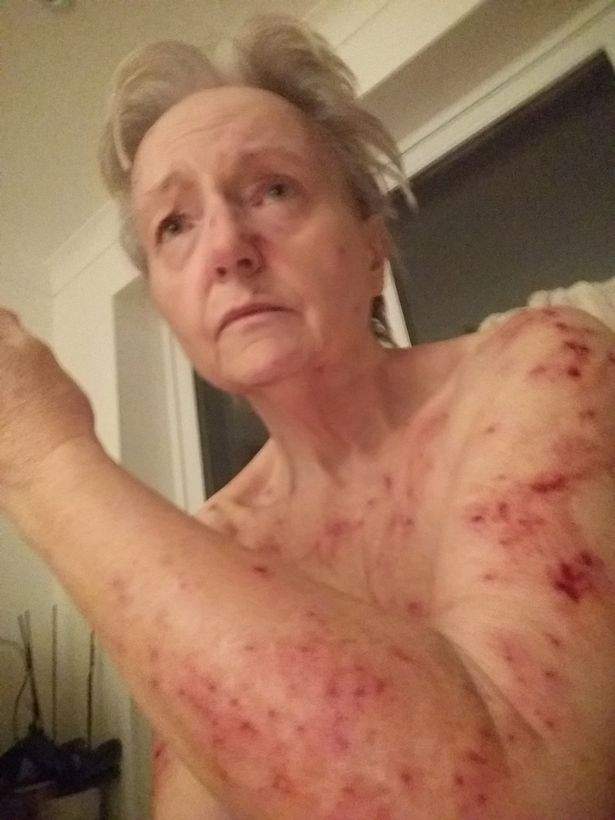 Imagini șocante! Cum arată femeia căreia i-au ieșit, la propriu, bube pe piele, din cauză că nu a mai primit pensia