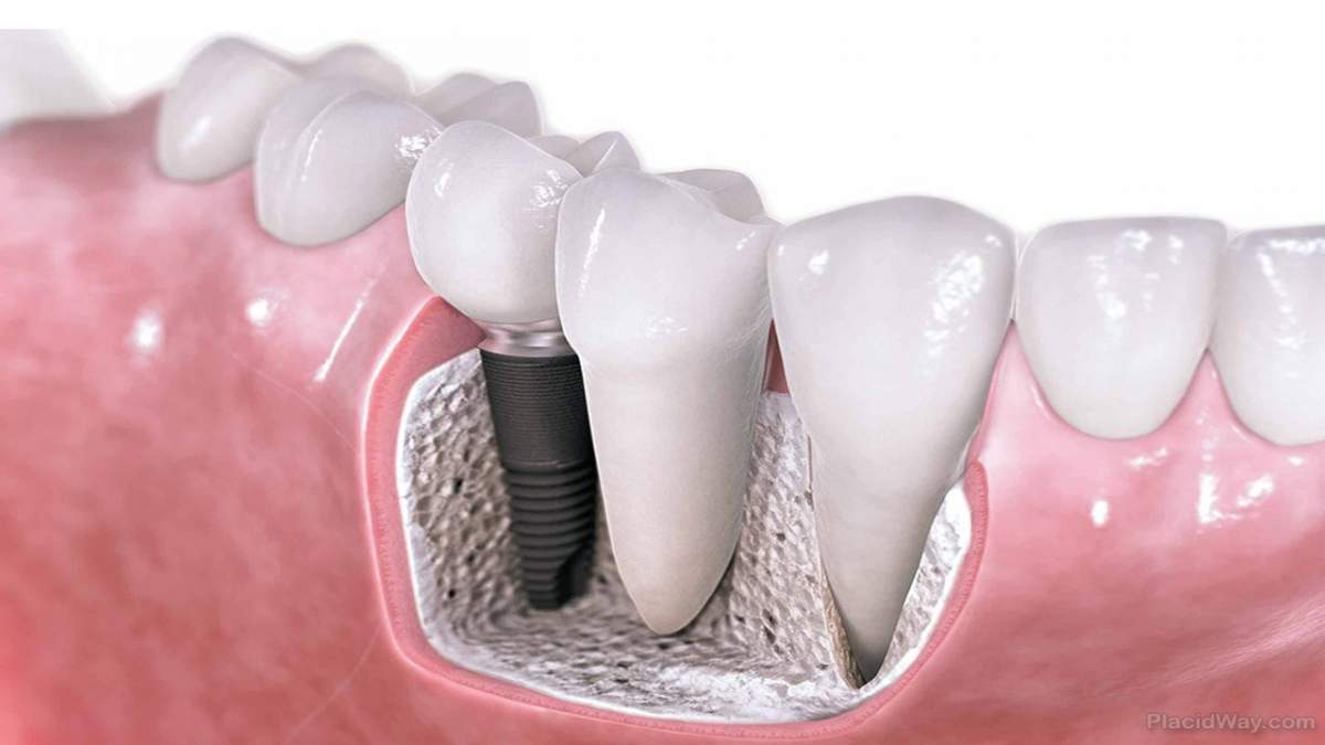 Cauti solutia optima de tratament? Incearca implanturile dentare!