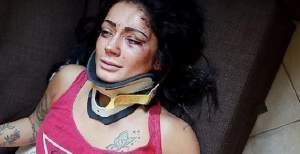 FOTO / Româncă bătută cu bestialitate în Italia! Alexandra este dansatoare şi a fost lovită fără milă de mai mulţi bărbaţi