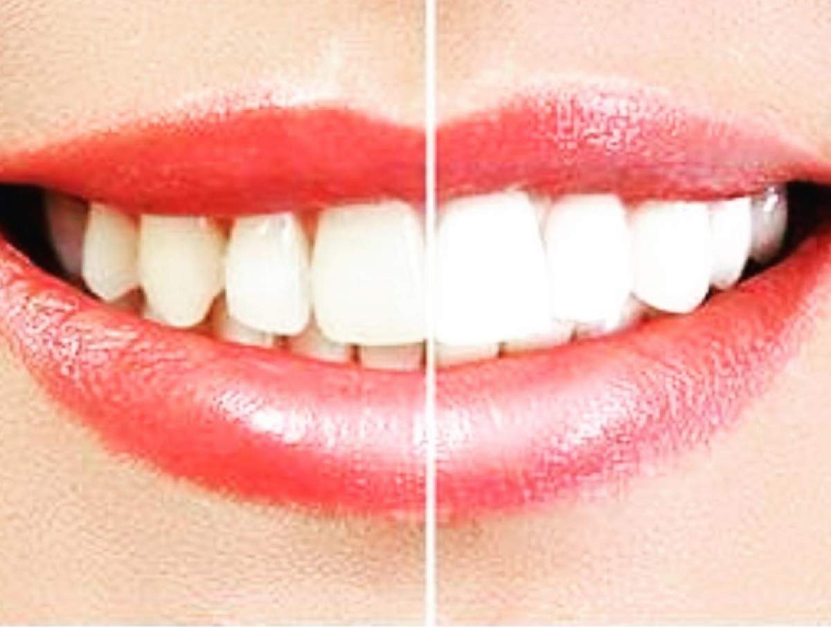 Albirea dinţilor este mai simplă ca niciodată! Foloseşte ingredient naturale pe care le ai acasă