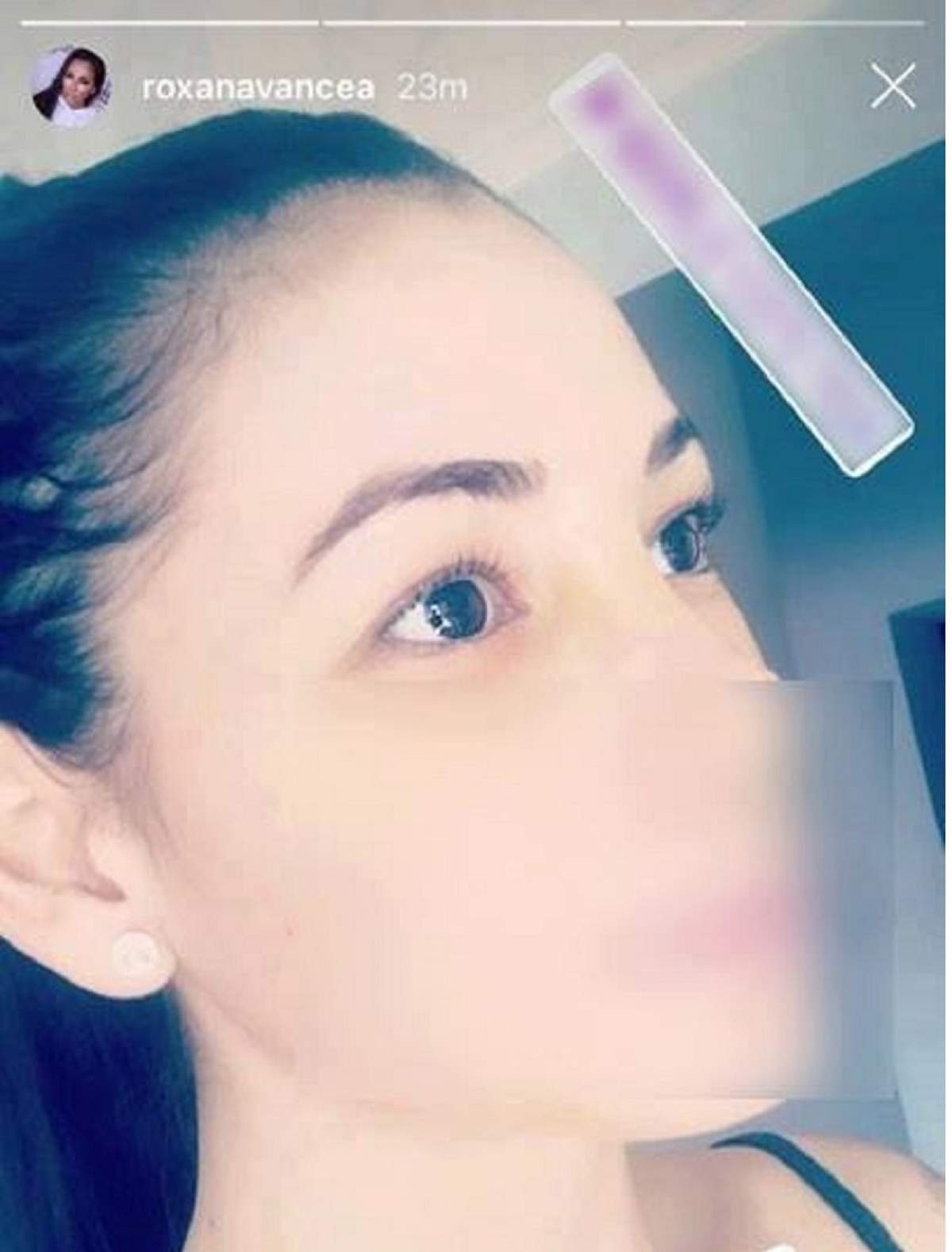 Primele imagini cu Roxana Vancea, la scurt timp după operaţia la nas / FOTO