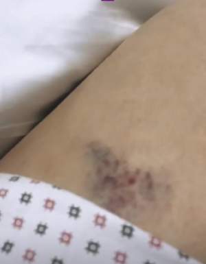 Andreea Bălan, cu vânătăi pe picioare, la spital! Poartă jambiere anti-tromboze. VIDEO