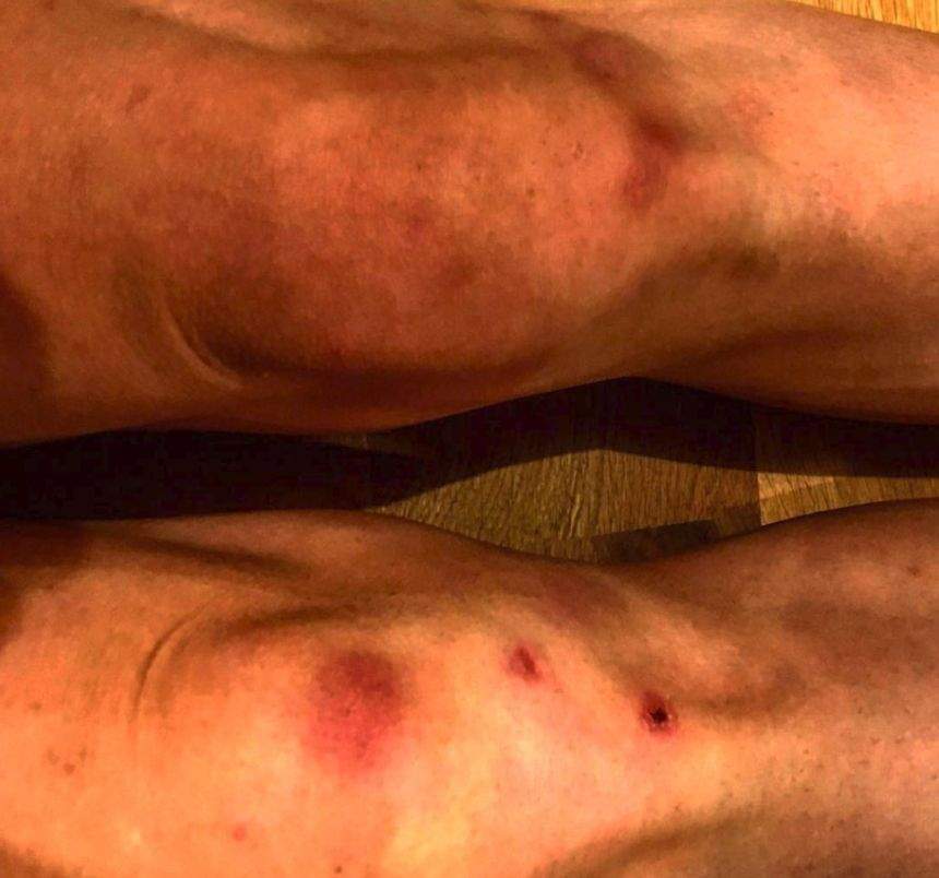 Sacrificiul pe care Mihai Bendeac îl face pentru fani. "Așa arată genunchii mei după o săptămână de spectacole la teatru"