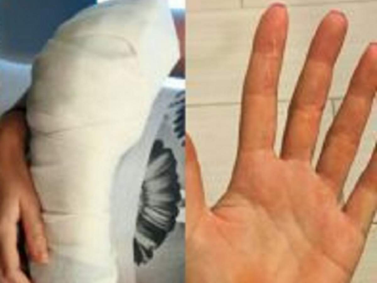 Un botoşănean de 19 ani a rămas fără patru degete, în timp ce pregătea un aluat