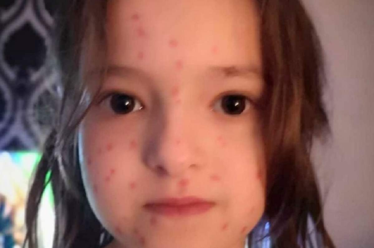 S-a prefăcut că are varicelă, doar pentru a scăpa de şcoală! Fetiţa de şase ani a regretat imediat