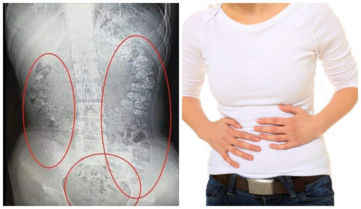 O tânără constipată a făcut o descoperire șocantă! Ce i-au putut găsi medicii în stomac