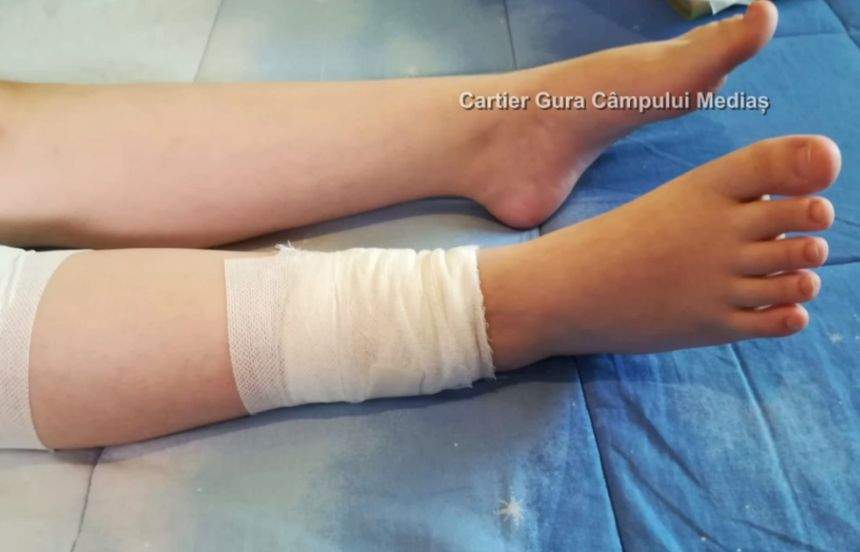 Copilă de 10 ani din Mediaş, atacată de un câine maidanez. Fetiţa a fost muşcată de nas, mâini şi de picioare