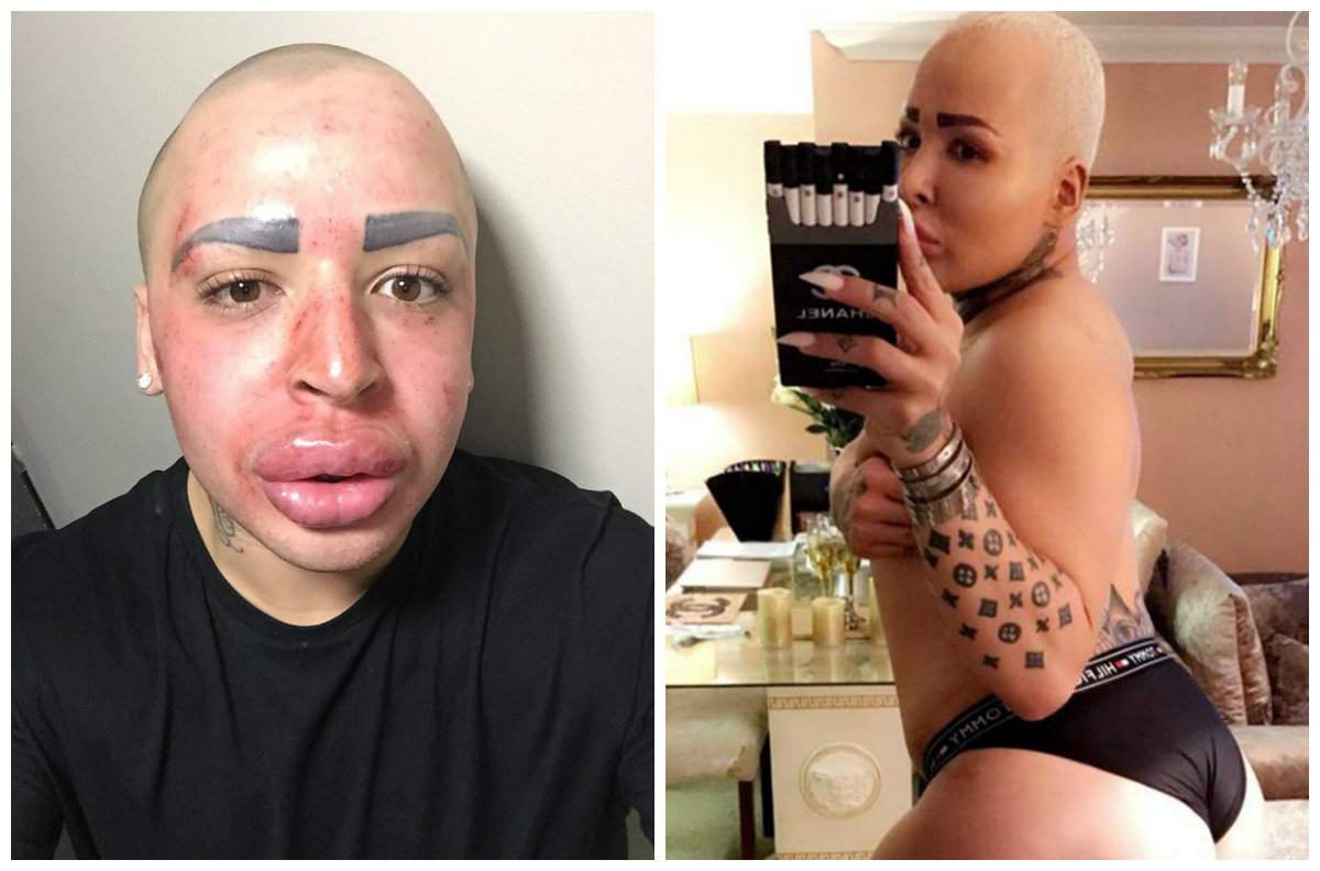 Bărbatul care vrea să semene cu Kim Kardashian aproape a fost ucis de implanturile în fese. Cum arăta înainte