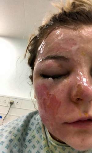 O tânără de 22 de ani a orbit, după ce a băgat ouă la microunde. Imagini de pe patul de spital