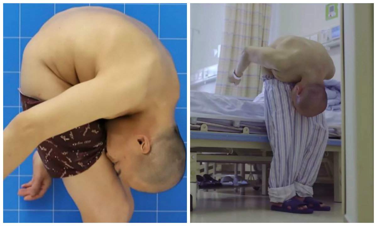 Caz medical incredibil! Bărbatul care a trăit zeci de ani cu fața lipită de coapse poate merge normal, după ce a fost operat