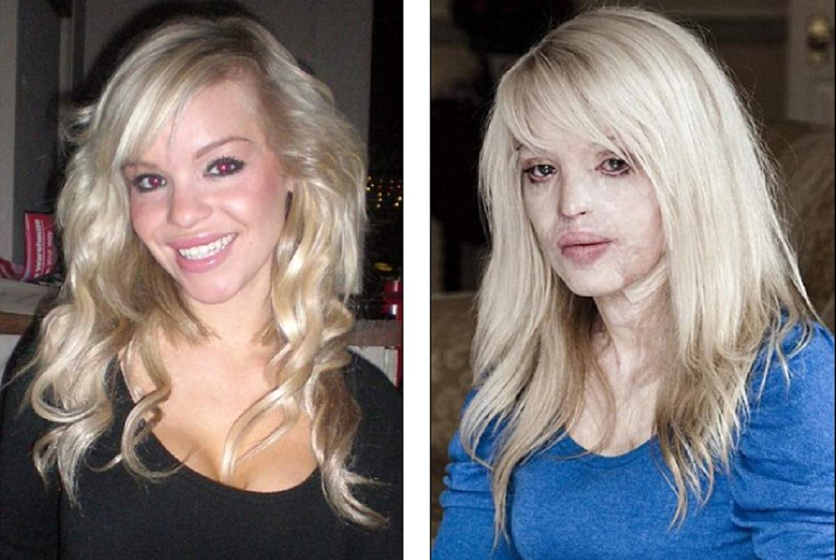 În urmă cu 12 ani, iubitul i-a aruncat acid sulfuric în față. Cum arată acum prezentatoarea Katie Piper