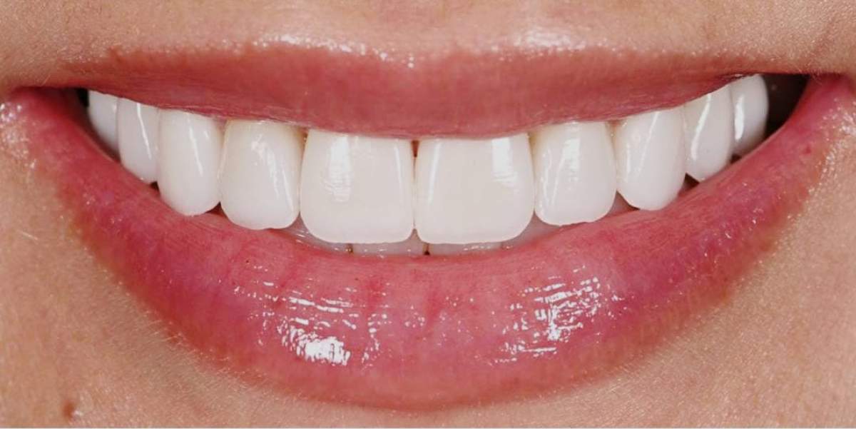Albirea dinților acasă. Tratamente naturale pentru un zâmbet frumos