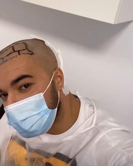Culiță Sterp își face implant de păr
