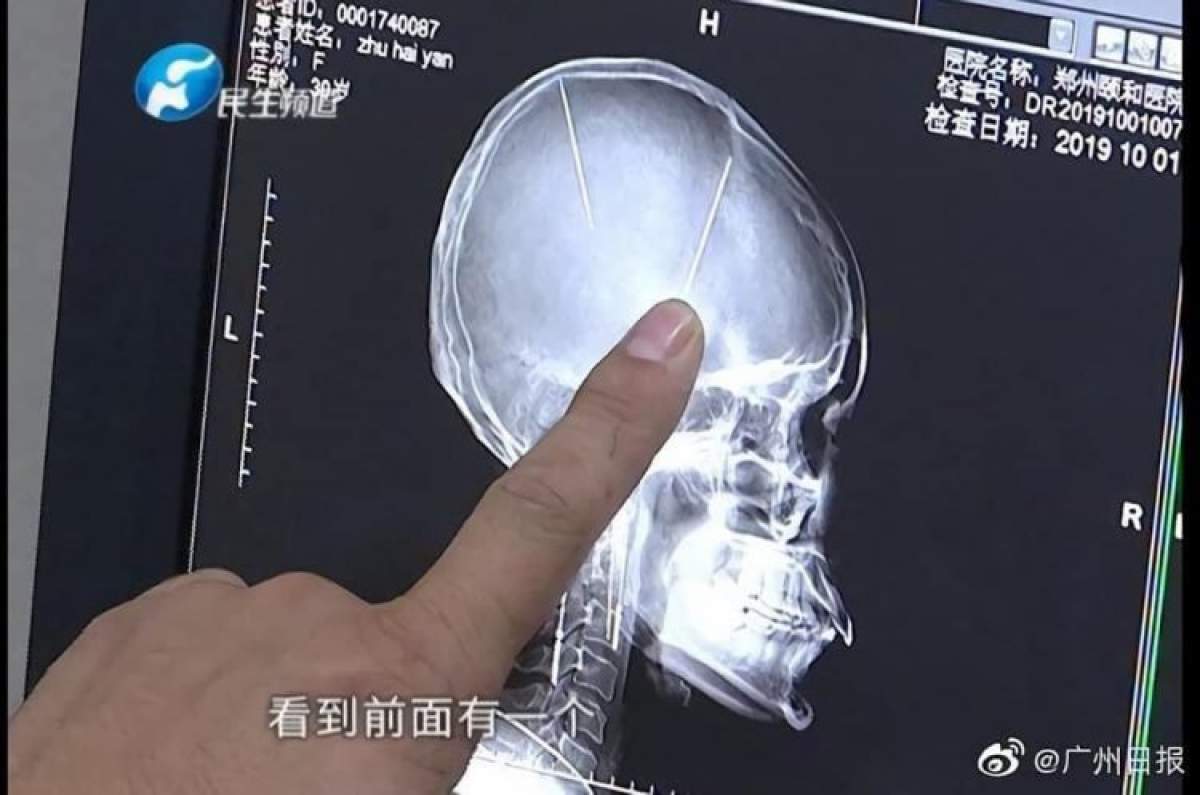 Radiografie cu ace în creierul unei femei din China