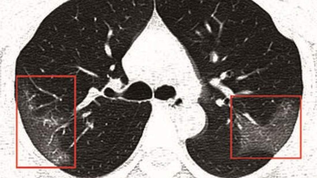 Plămânii, grav afectați de coronavirus! Cum arată organele, la trei zile de la infectare