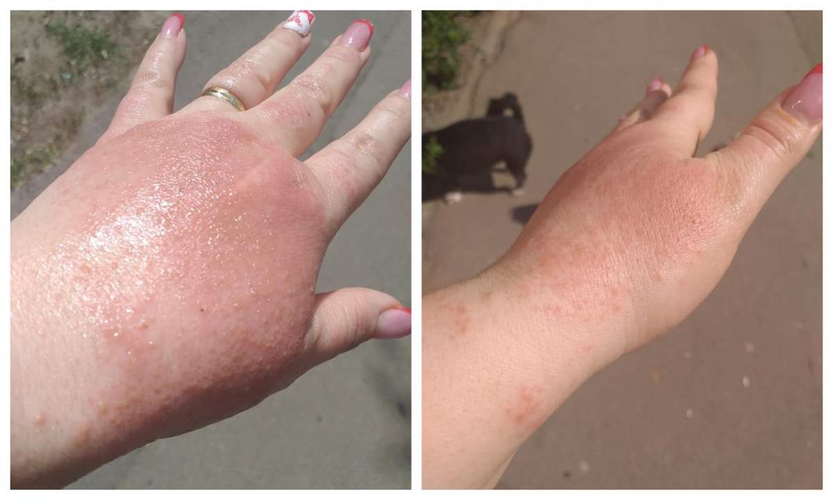 Brăila. O femeie s-a ales cu arsuri grave pe mâini, după ce a folosit un dezinfectant dintr-un supermarket