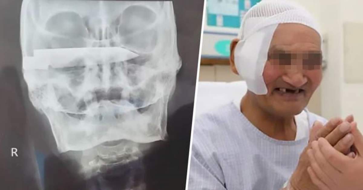Un real miracol! Bărbat operat pentru a i se scoate o lamă ruginită din cap, la 26 de ani după ce a fost înjunghiat