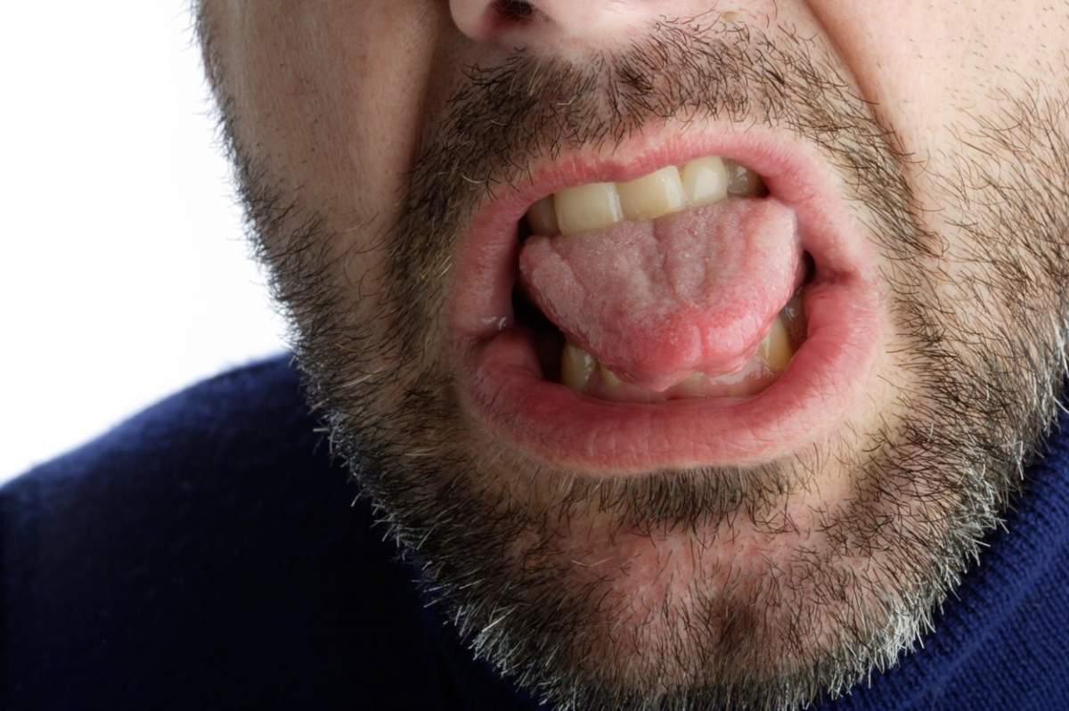 Un tânăr de 24 de ani și-a tăiat limba, pentru a „opri” pandemia de coronavirus. Era frustrat că nu se putea întoarce acasă