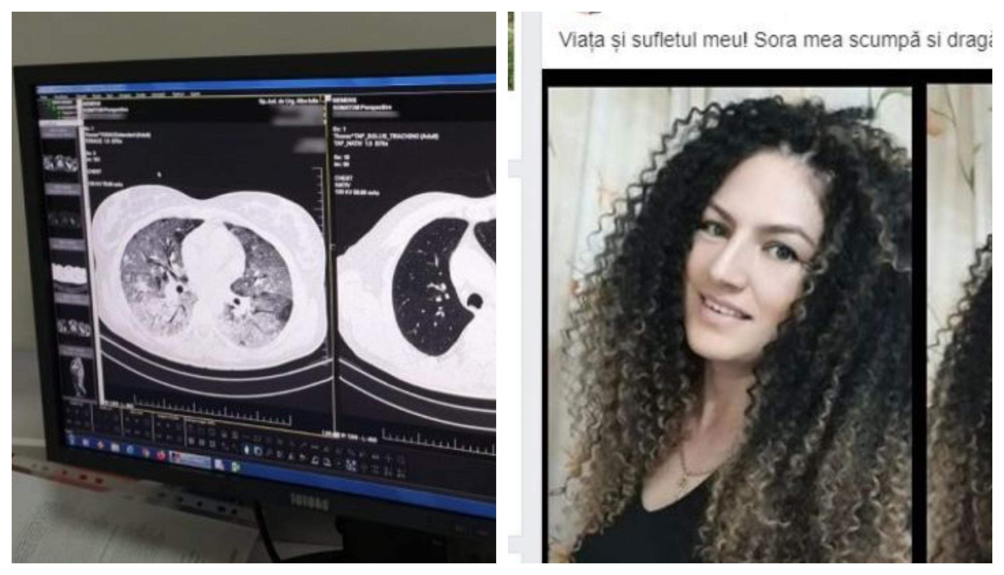 De ce a murit femeia de 39 de ani din Alba-Iulia, deși nu avea nici o boală! Cum arătau plămânii tinerei ucise de coronavirus / FOTO
