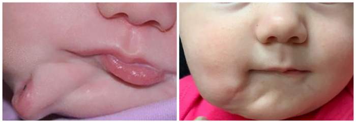 FOTO / Caz medical șocant! O fetiță s-a născut cu două guri! Cum arată micuța după intervenția doctorilor: ”Nu a fost nevoie de un alt tratament”