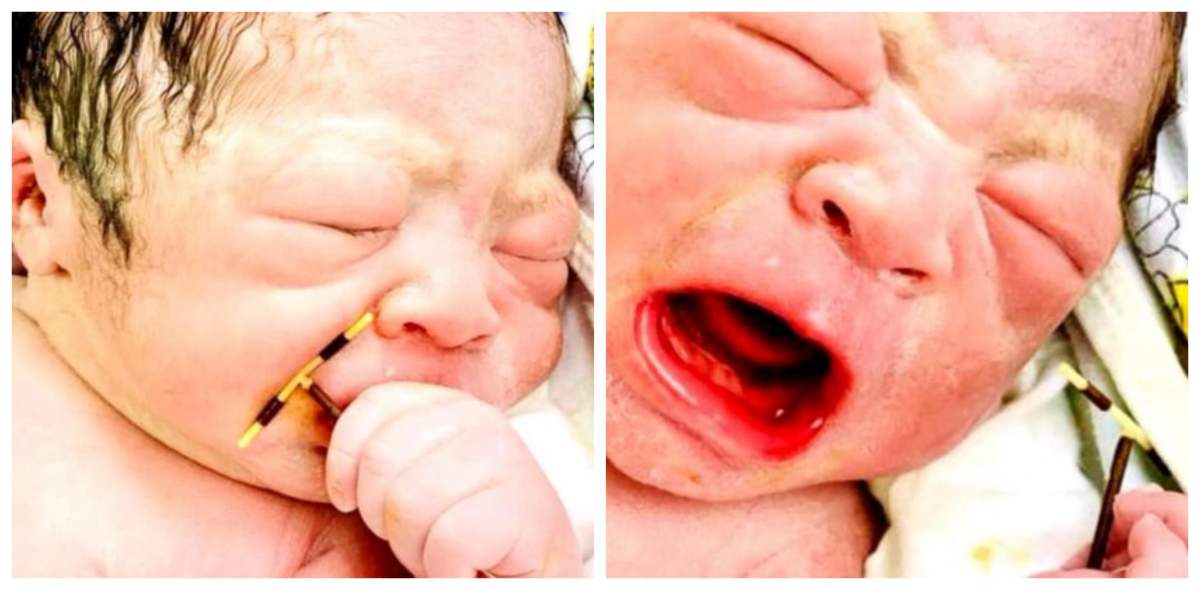 Bebeluș nedorit de părinți, venit pe lume cu orice preț! Șocant ce au găsit medicii în mâna copilului abia născut / FOTO