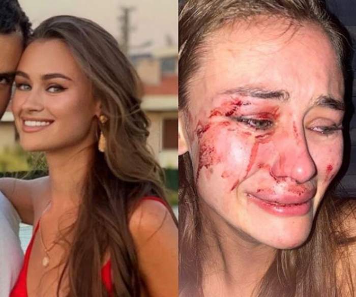 Daria, un celebru model, a fost bătută până la desfigurare pe o plajă! Tânăra a trecut printr-un calvar: „Am crezut că mi-am pierdut ochiul!”. Imagini șocante! / FOTO