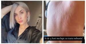 Imagine șocantă cu Adda! Soția lui Cătălin Rizea s-a afișat cu spatele plin de răni: „Mi-am neglijat corpul” / FOTO