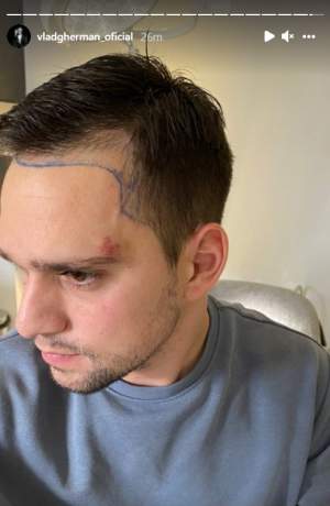 Vlad Gherman își face implant de păr. Actorul s-a lăsat pe mâna doctorului / FOTO