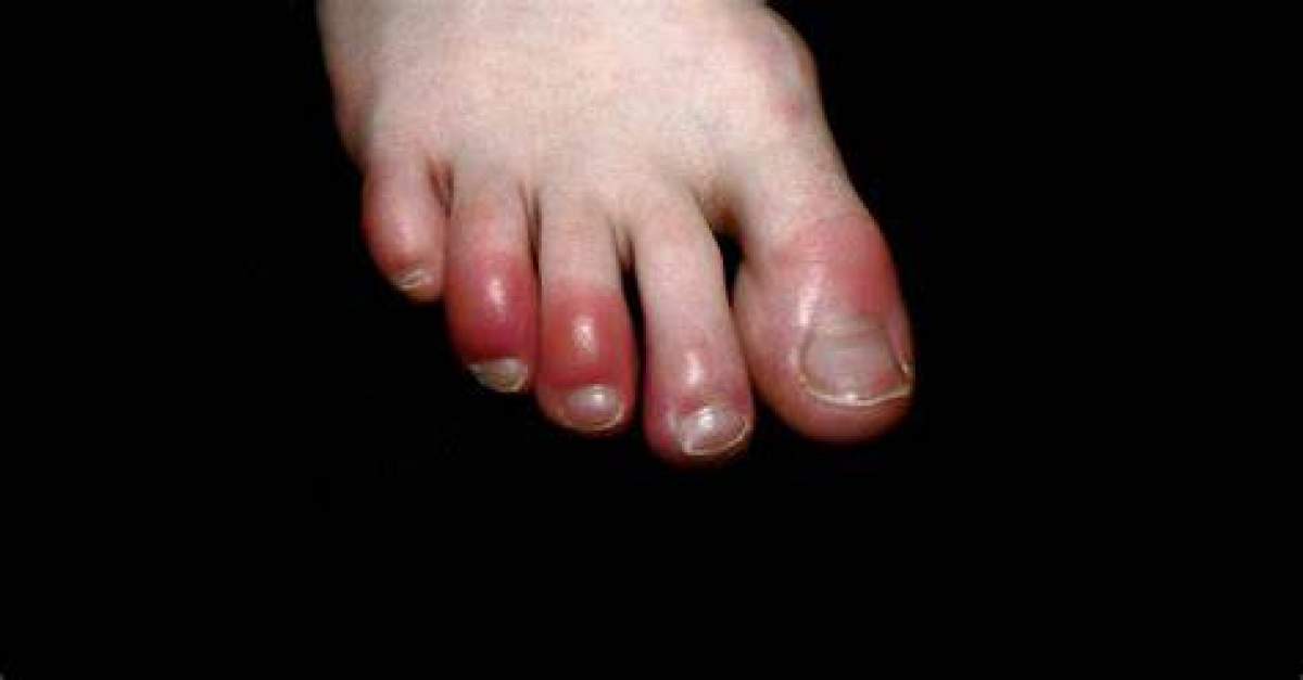 Care este motivul pentru care li se înroșesc degetele de la picioare bolnavilor cu COVID-19. Explicația medicilor