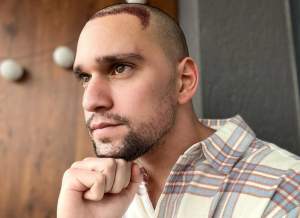 Cum arată Vlad Gherman după operația de implant de păr. Actorul se află în recuperare: ”Începe procesul de vindecare”
