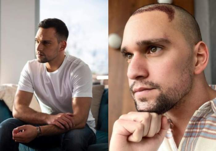 Cât costă implantul de păr, intervenția estetică pe care și-a făcut-o Vlad Gherman