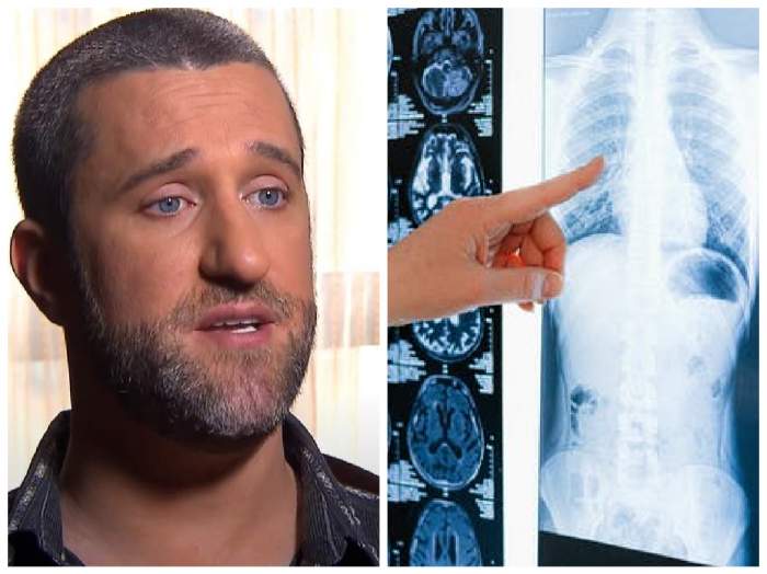 Dustin Diamond și o radiografie cu plămâni