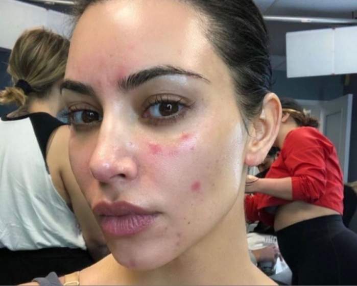 Kim Kardashian suferă de o boală incurabilă! Care este afecțiunea care nu îi dă pace divei / FOTO