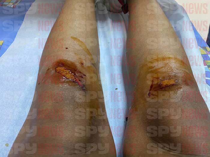 Primele imagini cu rănile lui Laurette, după ce a fost atacată cu bestialitate de către bărbatul din hotel / Exclusiv