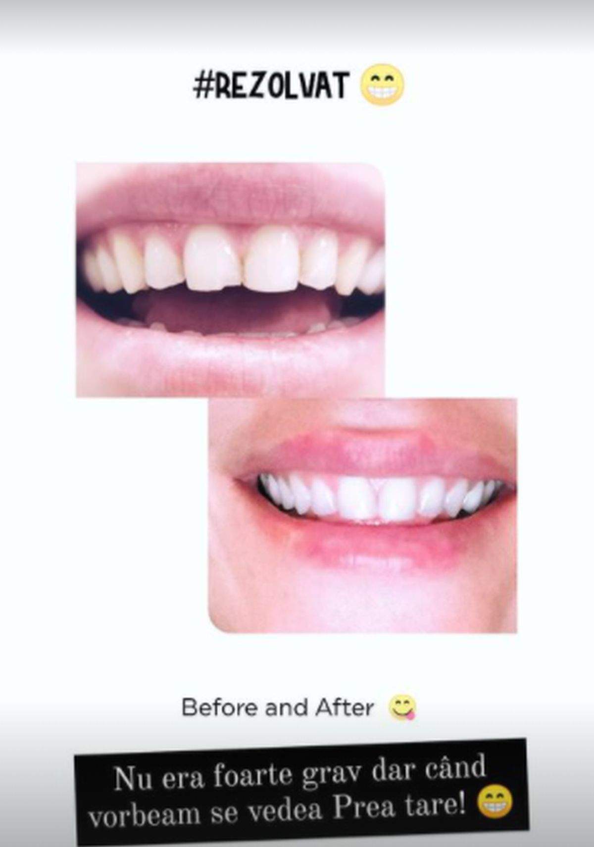 Dintele Alinei Pușcaș spart vs dintele reparat de soțul ei
