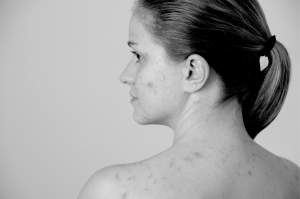 Ce boli ascunde pielea uscată și ce remedii există