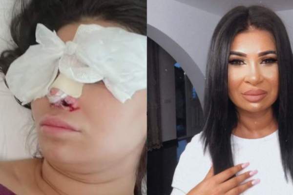 Ramona Manole, prima imagine după operația estetică pe care a suferit-o la nas. Cum arată artista acum / FOTO