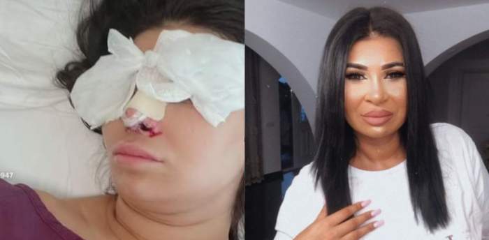 Ramona Manole, prima imagine după operația estetică pe care a suferit-o la nas. Cum arată artista acum / FOTO