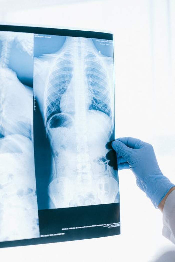 O radiografie ținută în mână de un medic