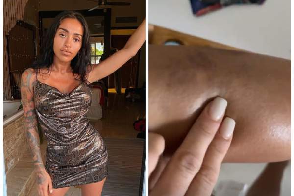 Ruby, plină de vânătăi pe picioare. Cântăreața le-a arătat fanilor imagini șocante: „De data asta nu sunt de la nuiaua lui Nea Marin” / VIDEO