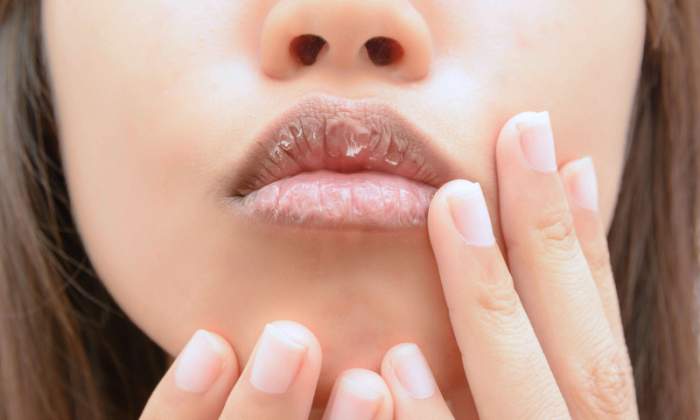 Ai buzele crăpate în sezonul rece? Remediul eficient pentru a le avea sănătoase