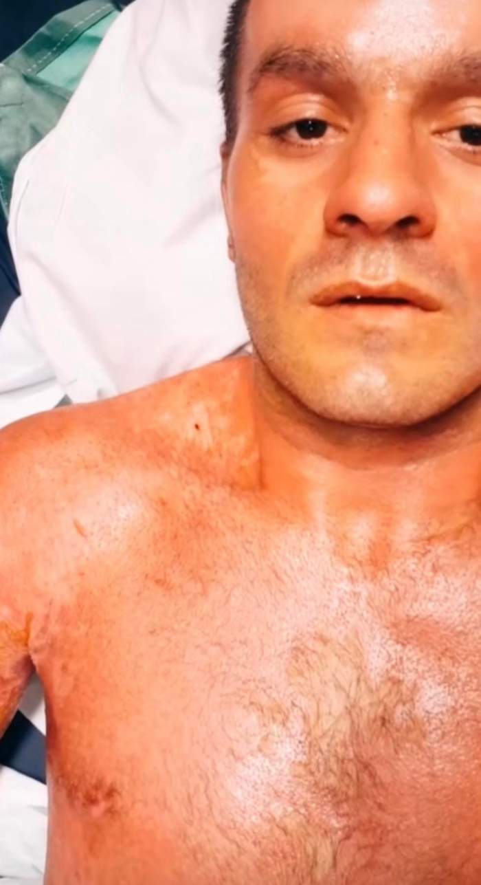 EXCLUSIV. Tiktokerul care și-a dat foc în direct a ieșit din comă! Cum arată acum și ce spun apropiații despre revenirea miraculoasă