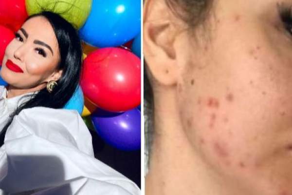 Andreea Mantea, probleme grave cu tenul. Ce a văzut vedeta pe fața ei după ce s-a demachiat: “Nu pot să înțeleg, serios!” / FOTO